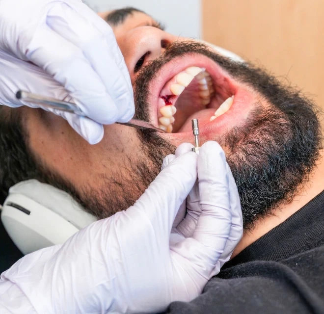 Dentist positioning a dental implant component during treatment in Mexico City.