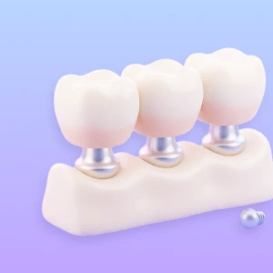 3D illustration of a fixed bridge seated on abutments with a fixation screw.