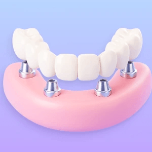 3D illustration of a full-arch bridge supported by four implants.