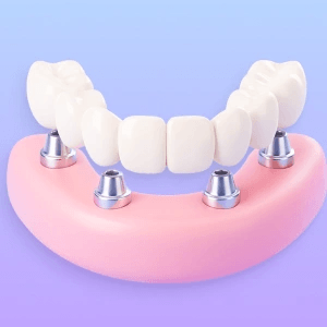 3D illustration of a fixed per-arch bridge on four implants.