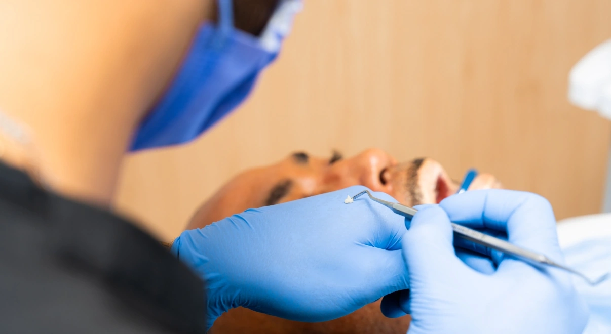 Dentista colocando una resina dental pequeña del color del diente.