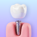 3D icon showing an implant root before the final crown.