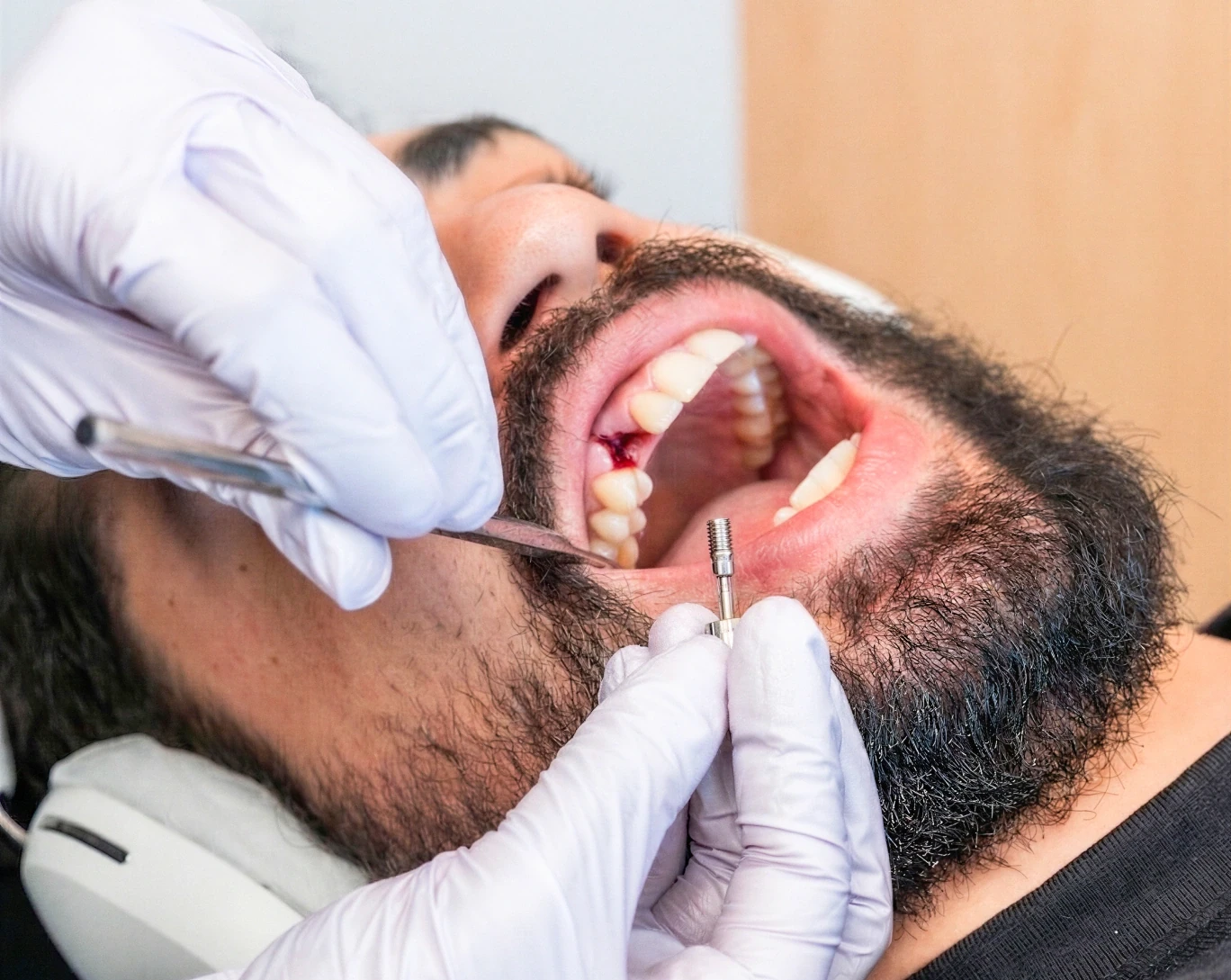 Single dental implant placement during surgery at hisonrisa in Roma Sur, Mexico City.