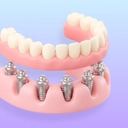 All-on-6 icon with a full-arch implant bridge.