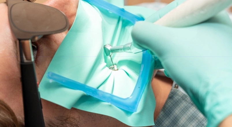 Root canal treatment isolated with a rubber dam during endodontic care.