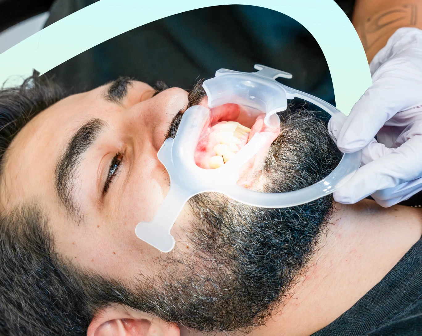 Patient during in-office teeth whitening at hisonrisa in Roma Sur, Mexico City.